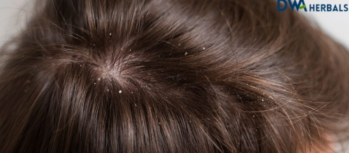 Dandruff - Herbal water for Dandruff